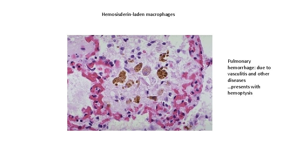Hemosisderin-laden macrophages Pulmonary hemorrhage: due to vasculitis and other diseases …presents with hemoptysis 