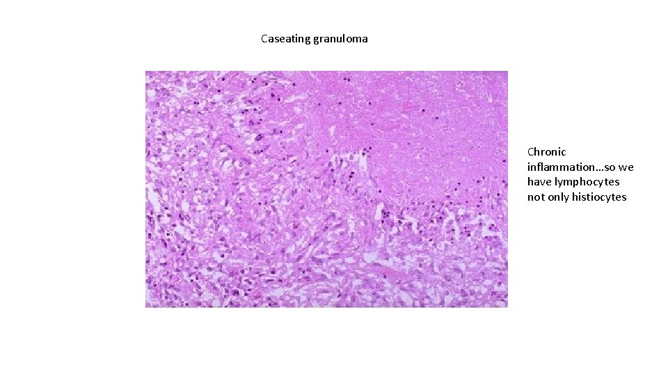 Caseating granuloma Chronic inflammation…so we have lymphocytes not only histiocytes 