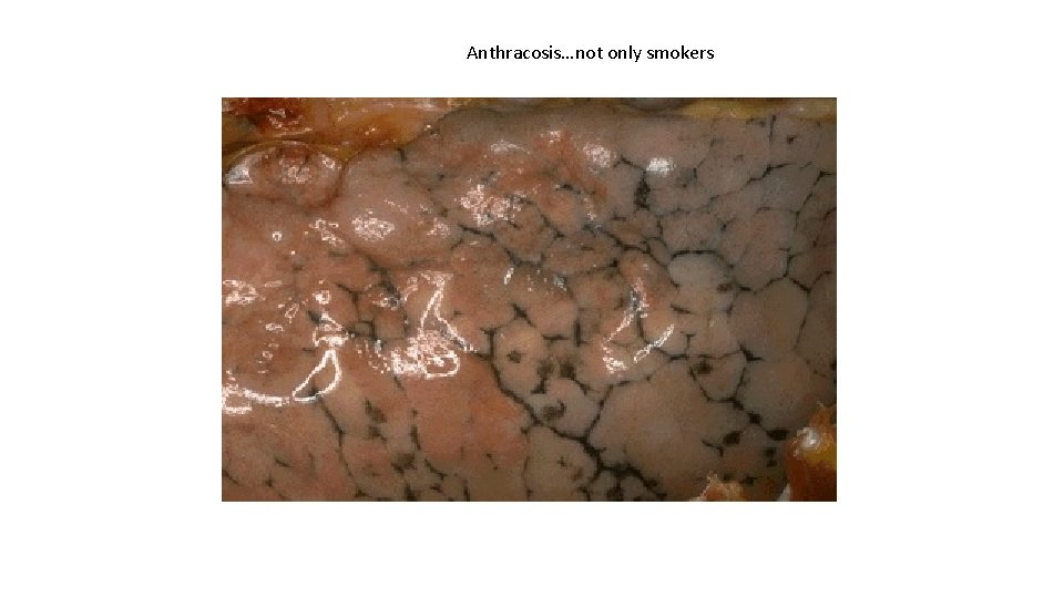 Anthracosis…not only smokers 