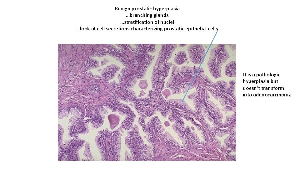 Benign prostatic hyperplasia …branching glands …stratification of nuclei …look at cell secretions characterizing prostatic