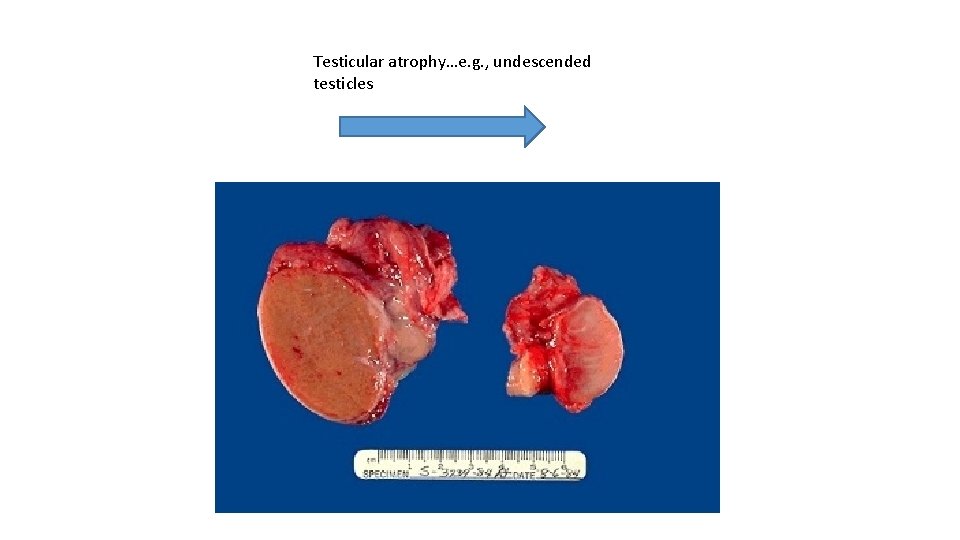 Testicular atrophy…e. g. , undescended testicles 