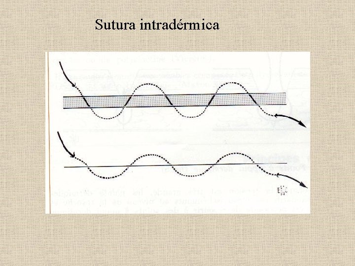 Sutura intradérmica 