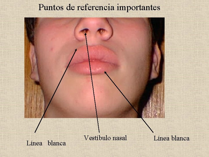 Puntos de referencia importantes Línea blanca Vestíbulo nasal Línea blanca 