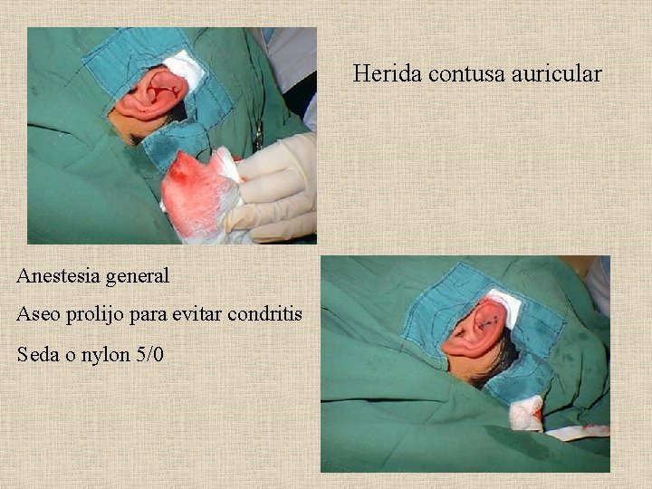 Herida contusa auricular Anestesia general Aseo prolijo para evitar condritis Seda o nylon 5/0