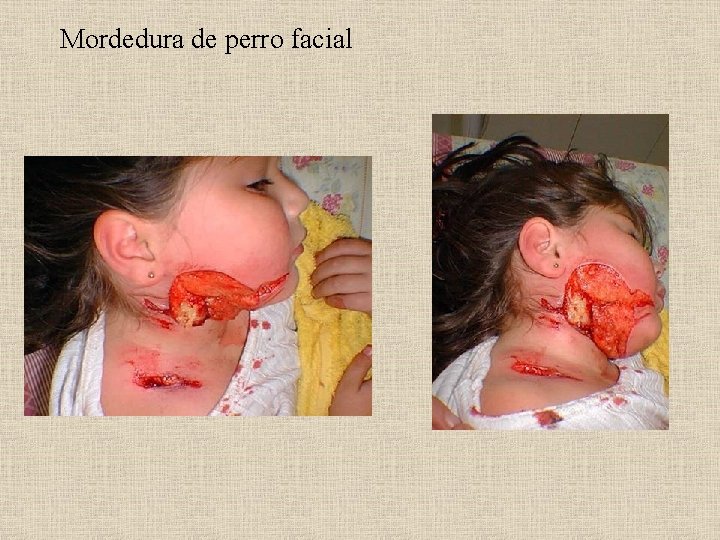 Mordedura de perro facial 