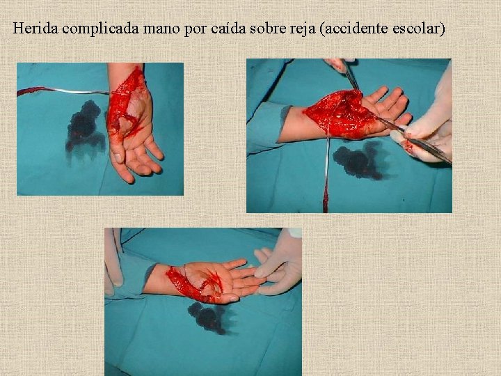 Herida complicada mano por caída sobre reja (accidente escolar) 