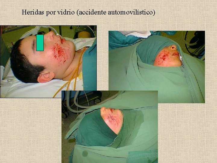 Heridas por vidrio (accidente automovilístico) 