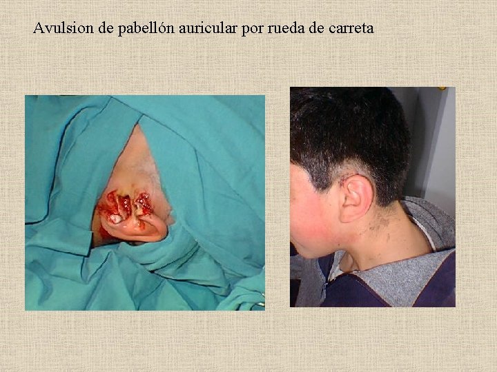 Avulsion de pabellón auricular por rueda de carreta 