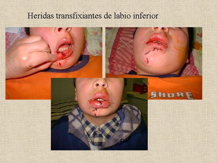 Heridas transfixiantes de labio inferior 