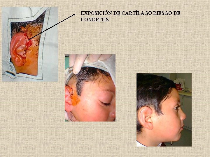 EXPOSICIÓN DE CARTÍLAGO RIESGO DE CONDRITIS 