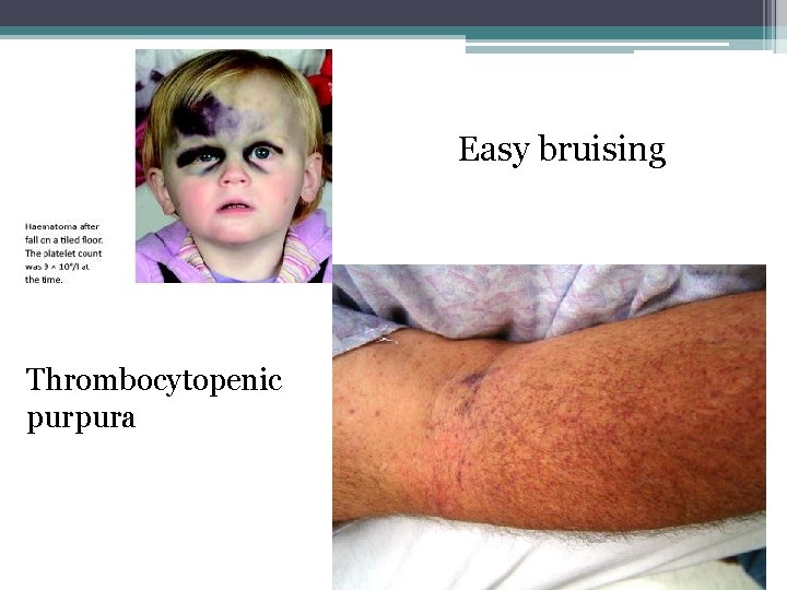 Easy bruising Thrombocytopenic purpura 