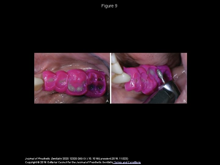 Figure 9 Journal of Prosthetic Dentistry 2020 12320 -26 DOI: (10. 1016/j. prosdent. 2018.