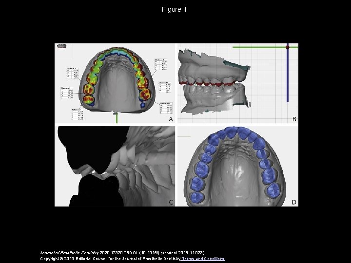 Figure 1 Journal of Prosthetic Dentistry 2020 12320 -26 DOI: (10. 1016/j. prosdent. 2018.