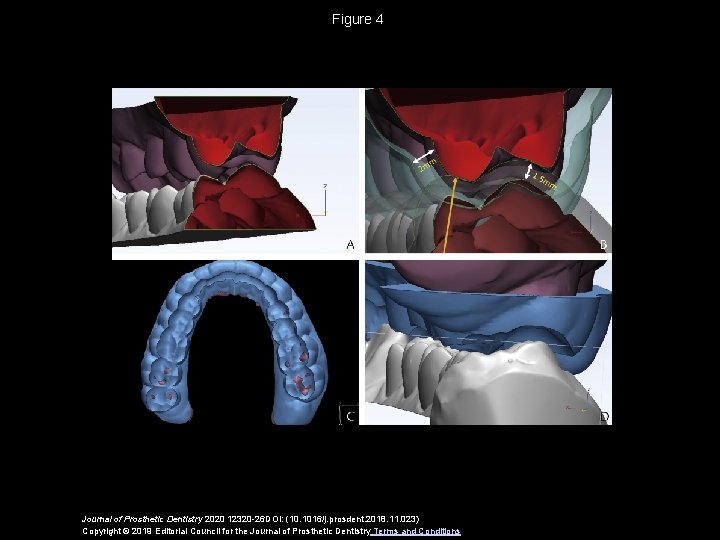 Figure 4 Journal of Prosthetic Dentistry 2020 12320 -26 DOI: (10. 1016/j. prosdent. 2018.