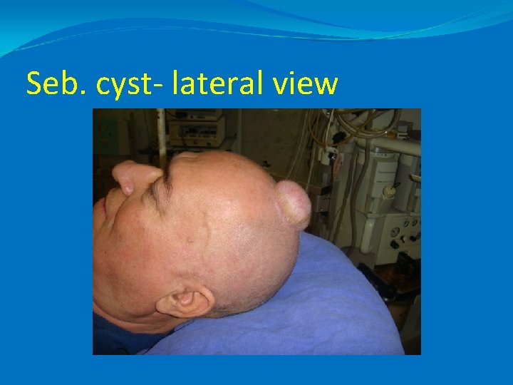 Seb. cyst- lateral view 