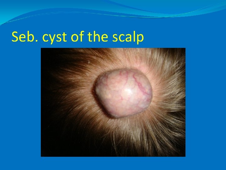 Seb. cyst of the scalp 