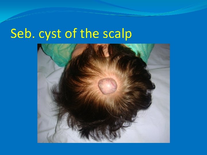 Seb. cyst of the scalp 