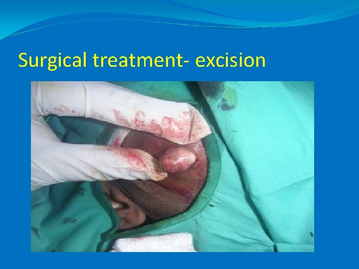 Surgical treatment- excision 