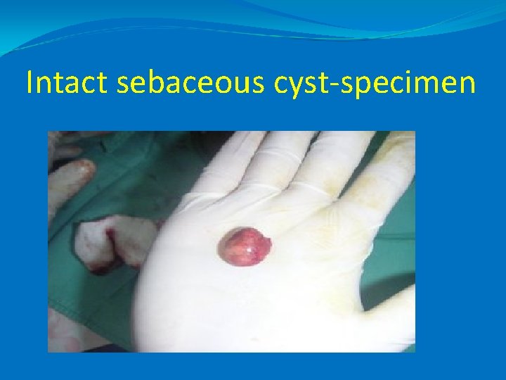 Intact sebaceous cyst-specimen 