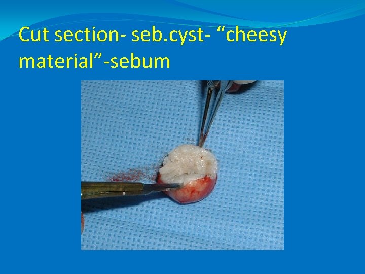 Cut section- seb. cyst- “cheesy material”-sebum 