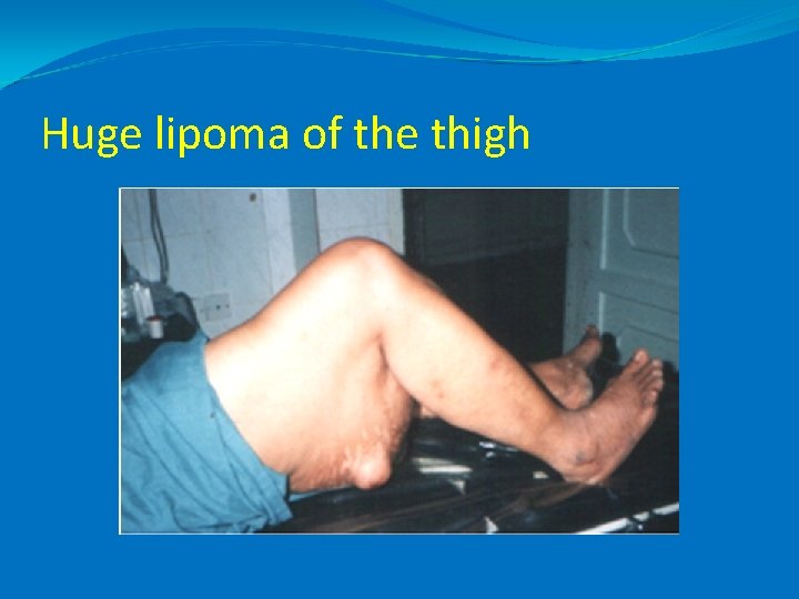 Huge lipoma of the thigh 