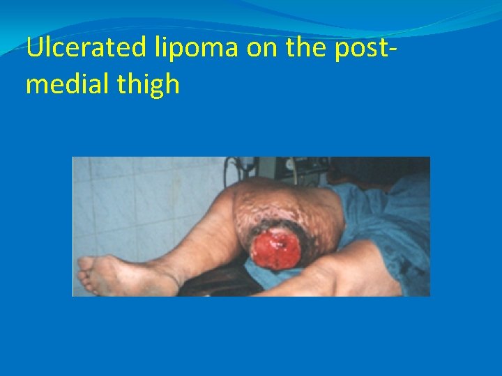 Ulcerated lipoma on the postmedial thigh 