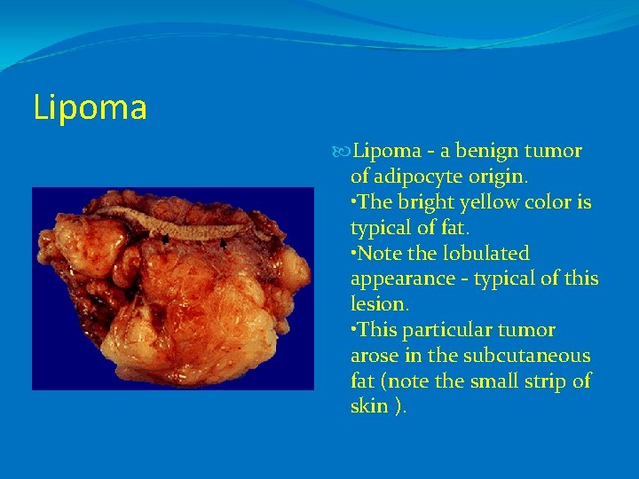 Lipoma - a benign tumor of adipocyte origin. • The bright yellow color is