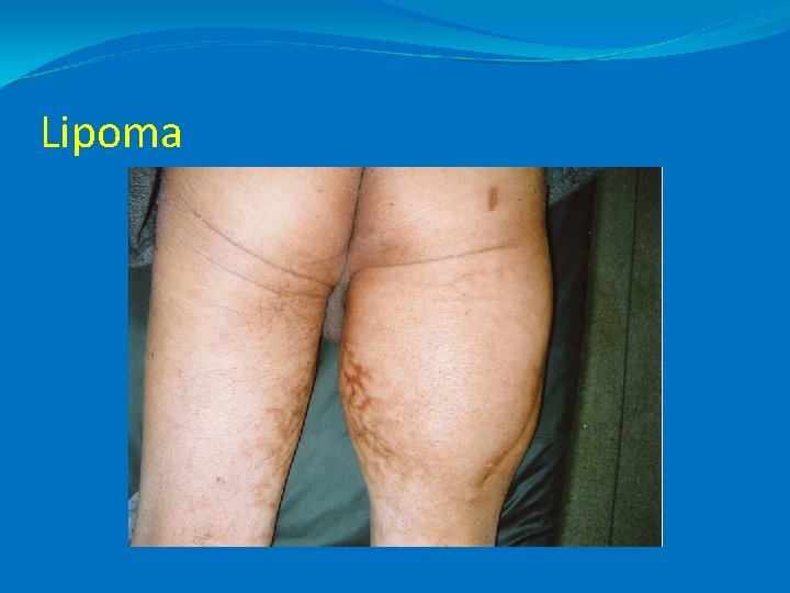 Lipoma 