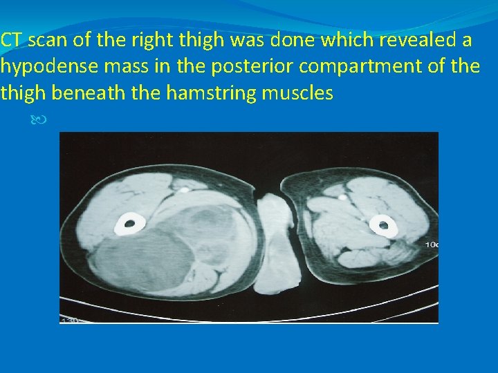 CT scan of the right thigh was done which revealed a hypodense mass in