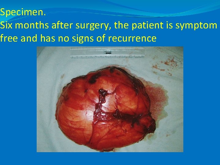 Specimen. Six months after surgery, the patient is symptom free and has no signs