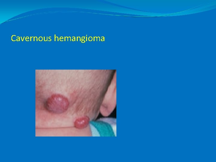 Cavernous hemangioma 