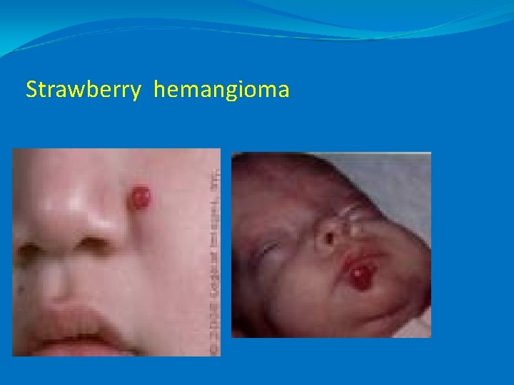 Strawberry hemangioma 