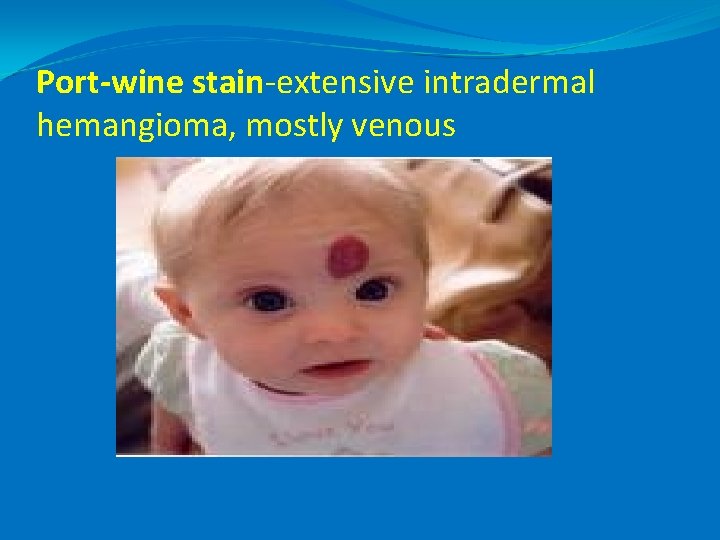 Port-wine stain-extensive intradermal hemangioma, mostly venous 