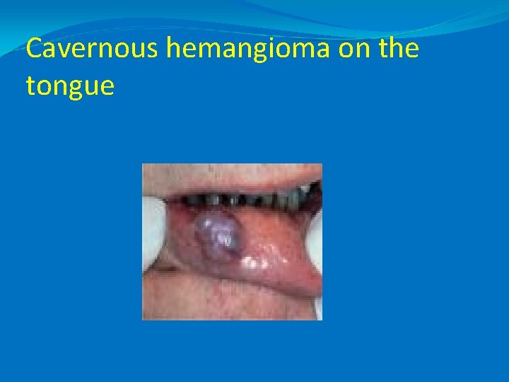 Cavernous hemangioma on the tongue 