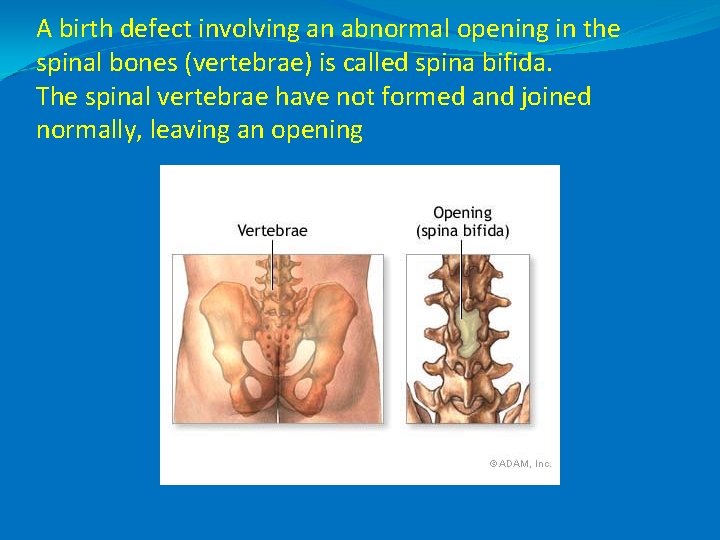 A birth defect involving an abnormal opening in the spinal bones (vertebrae) is called