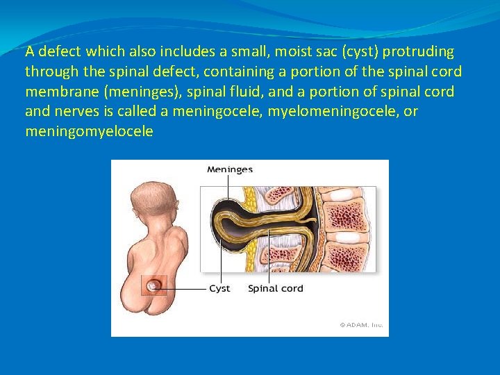 A defect which also includes a small, moist sac (cyst) protruding through the spinal