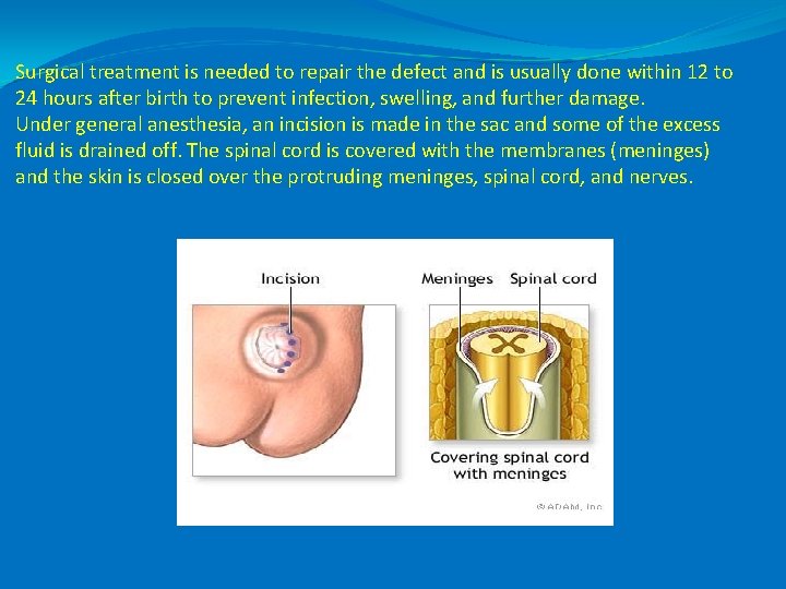 Surgical treatment is needed to repair the defect and is usually done within 12