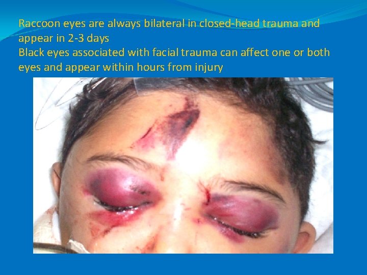Raccoon eyes are always bilateral in closed-head trauma and appear in 2 -3 days