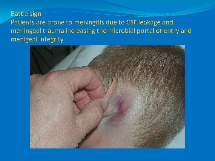 Battle sign Patients are prone to meningitis due to CSF leakage and meningeal trauma