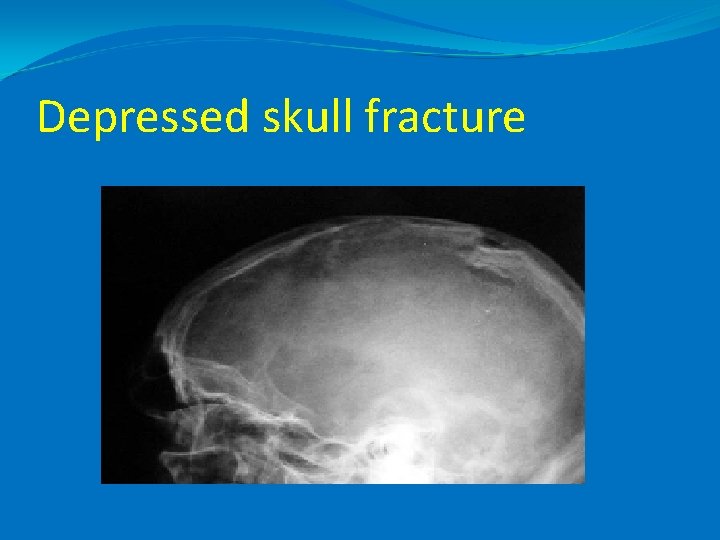 Depressed skull fracture 