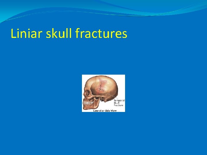 Liniar skull fractures 