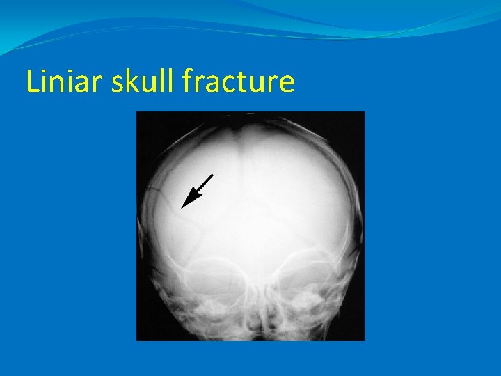 Liniar skull fracture 