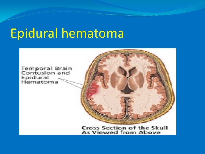 Epidural hematoma 