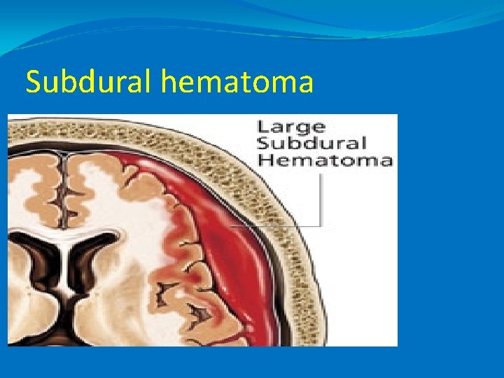 Subdural hematoma 