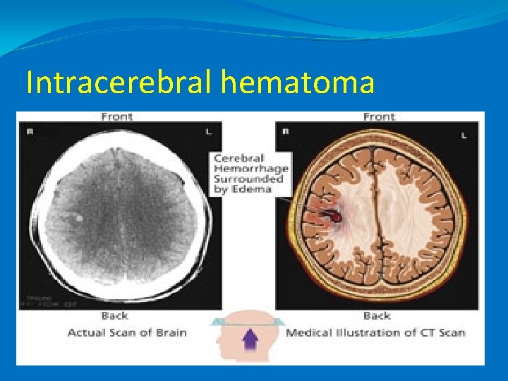 Intracerebral hematoma 