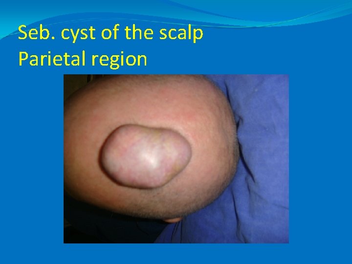 Seb. cyst of the scalp Parietal region 