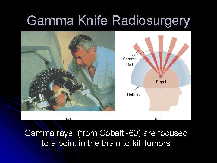 Gamma Knife Radiosurgery Gamma rays (from Cobalt -60) are focused to a point in