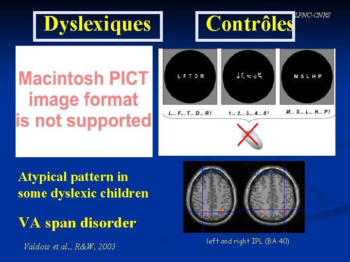 Dyslexiques Atypical pattern in some dyslexic children LPNC-CNRS Contrôles -30/-50/41 33/-53/45 VA span disorder