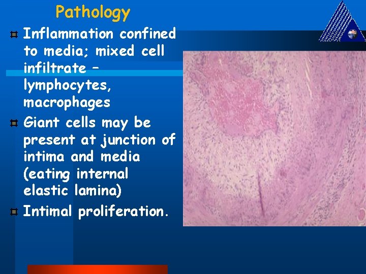 Pathology Inflammation confined to media; mixed cell infiltrate – lymphocytes, macrophages Giant cells may