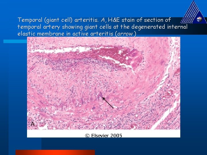 Temporal (giant cell) arteritis. A, H&E stain of section of temporal artery showing giant